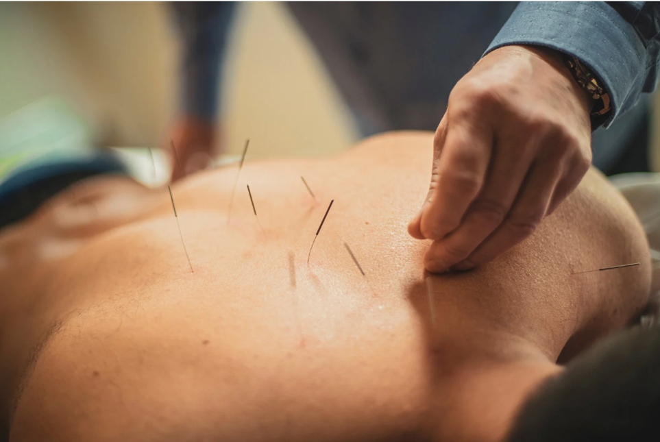 Acupuncture needles placed on a patient’s back during treatment at Balance Naturopathic & Acupuncture.