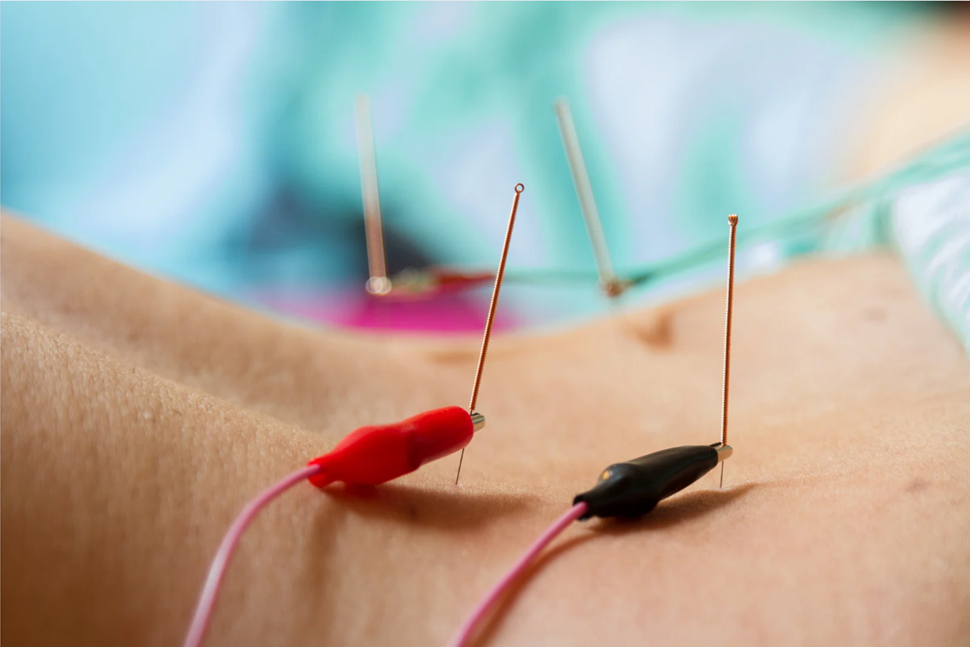 Dry Needling vs. Acupuncture: What’s the Difference?